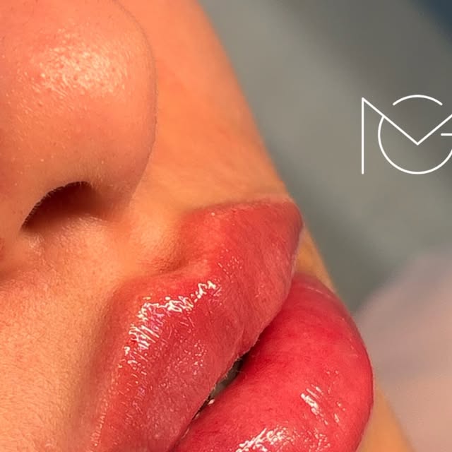 Preenchimento labial resultado